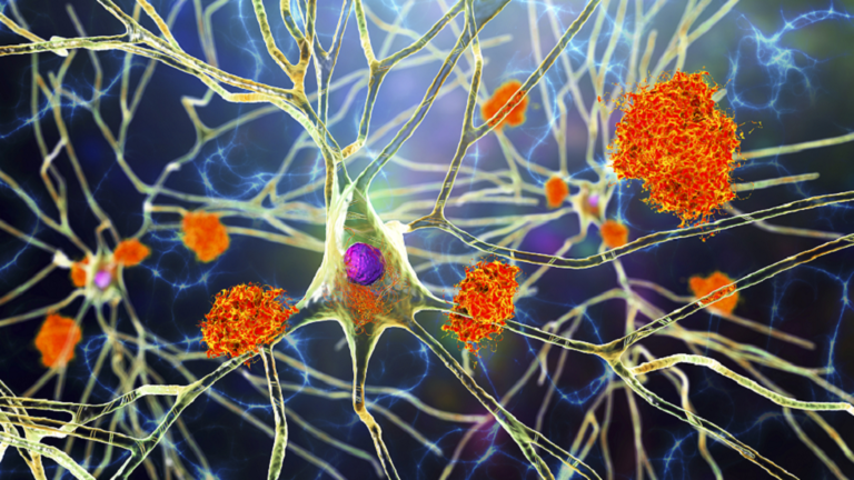 “السبب الخفي” لمرض ألزهايمر!